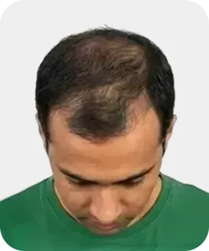 Stage 4